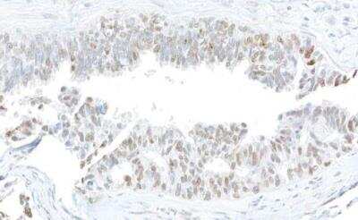 Immunohistochemical Detection of Histone H2AX in Paraffin Embedded Human Ovarian Carcinoma
